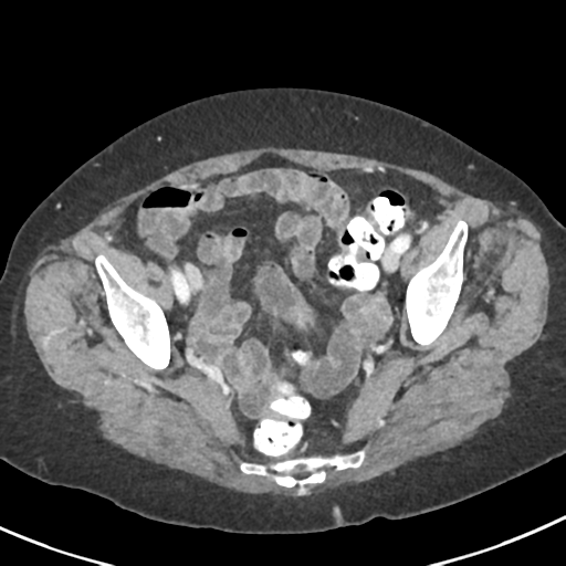 Ampullary adenocarcinoma (Radiopaedia 34013-35237 C 47).png