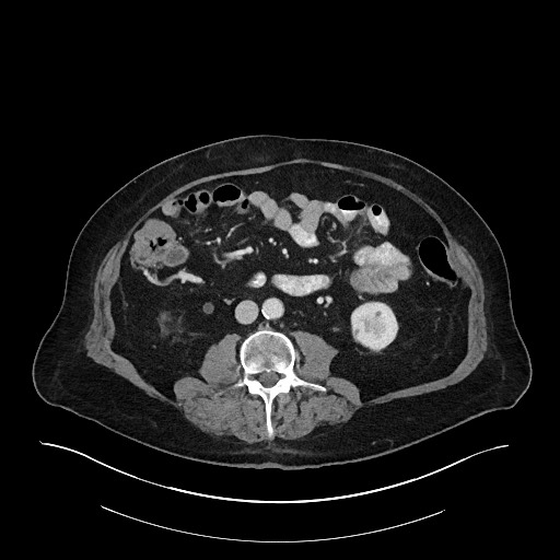 Ampullary adenocarcinoma (Radiopaedia 59373-66734 C 86).jpg