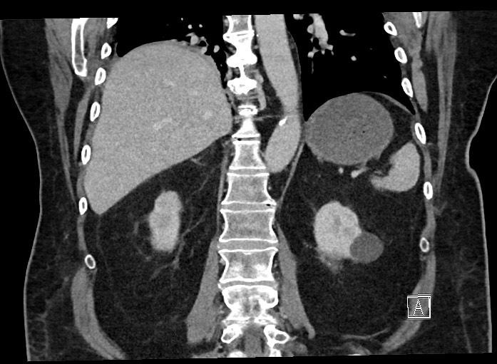 Ampullary adenocarcinoma (Radiopaedia 59373-66737 B 52).jpg
