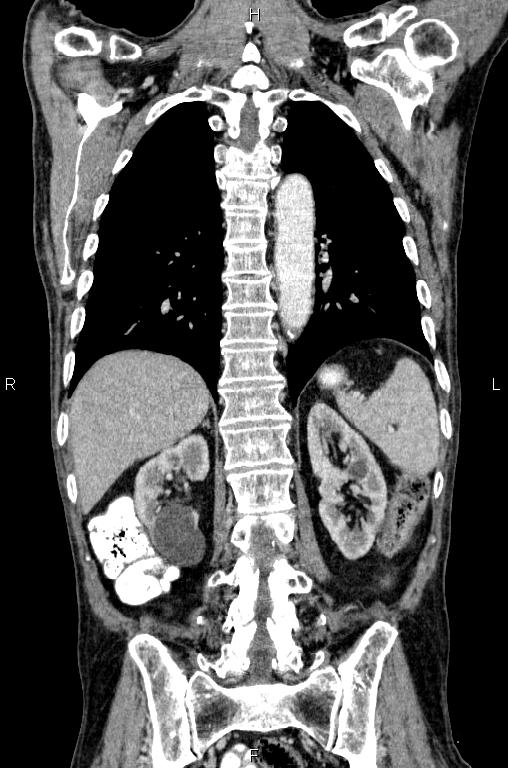 Ampullary adenocarcinoma (Radiopaedia 86093-102033 D 44).jpg