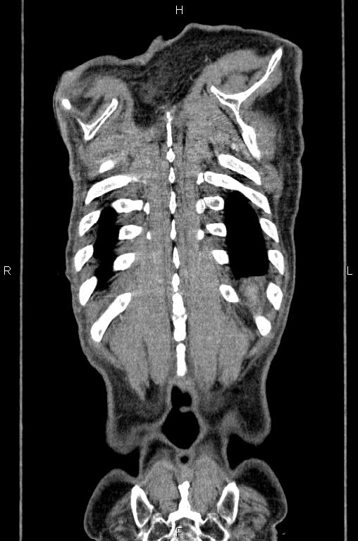 Ampullary adenocarcinoma (Radiopaedia 86093-102033 D 59).jpg