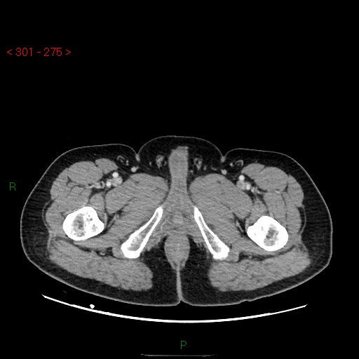 Ampullary carcinoma (Radiopaedia 56396-63056 C 111).jpg