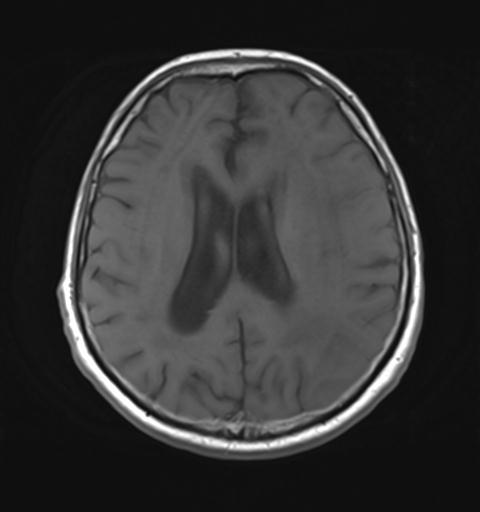 File:Amyloid angiopathy with inflammation (Radiopaedia 30360-31002 Axial T1 21).jpg