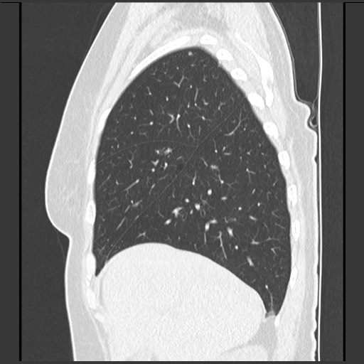 Amyloidosis - bronchial and diffuse nodular pulmonary involvement (Radiopaedia 60156-67744 F 13).jpg
