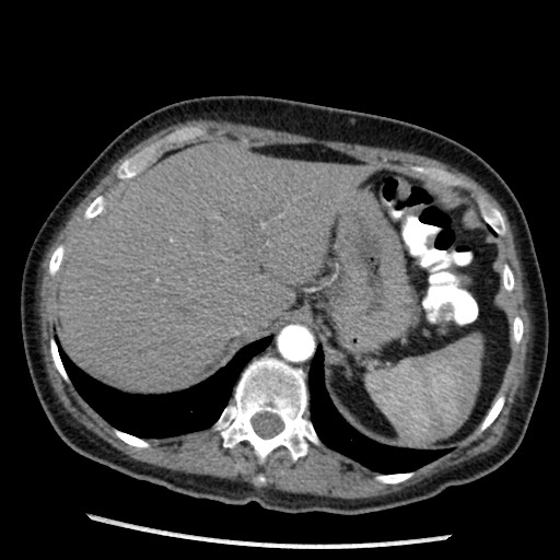File:Amyloidosis - bronchial and diffuse nodular pulmonary involvement (Radiopaedia 60156-67745 A 50).jpg