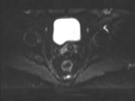 Anal adenocarcinoma - tumor regression grade 1 (Radiopaedia 31358-32100 Axial DWI 21).jpg
