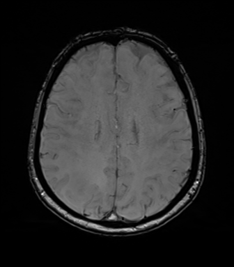Anaplastic astrocytoma (Radiopaedia 86943-103160 Axial SWI 60).png