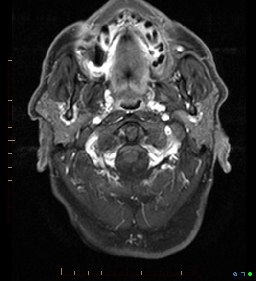 File:Anaplastic astrocytoma (WHO grade III) of the septum pellucidum (Radiopaedia 39365-41633 Axial T1 C+ fat sat 1).jpg