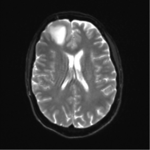 File:Anaplastic astrocytoma IDH mutant (Radiopaedia 50046-55341 Axial DWI 17).png