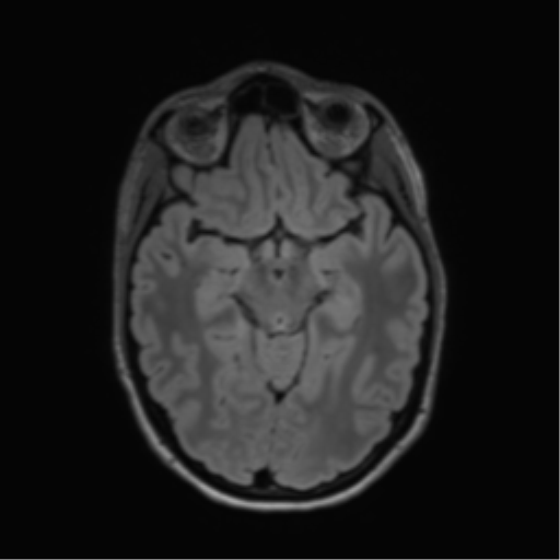 File:Anaplastic astrocytoma IDH mutant (Radiopaedia 50046-55341 Axial FLAIR 21).png