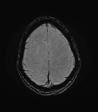 File:Anaplastic astrocytoma IDH mutant (Radiopaedia 50046-55341 Axial SWI 72).png