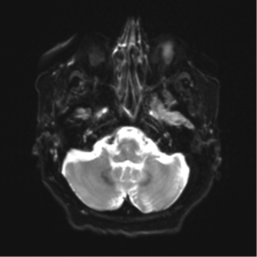 Anaplastic astrocytoma IDH wild-type (pseudoprogression) (Radiopaedia 42209-45279 Axial DWI 6).png