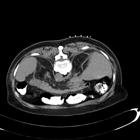 File:Anaplastic lymphoma - with CT biopsy (Radiopaedia 21643-21602 Axial non-contrast 11).jpg