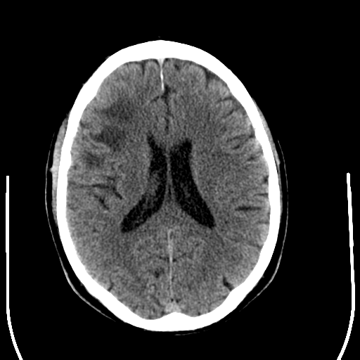 File:Anaplastic meningioma with recurrence (Radiopaedia 34452-35781 Axial non-contrast 20).png