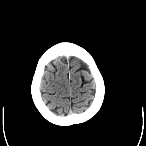 File:Anaplastic meningioma with recurrence (Radiopaedia 34452-35781 Axial non-contrast 29).png