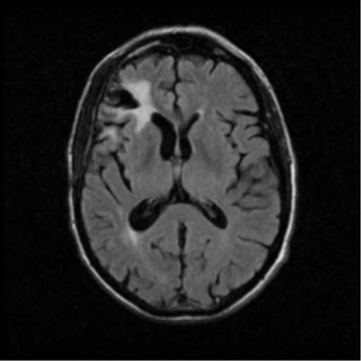 File:Anaplastic meningioma with recurrence (Radiopaedia 34452-35789 Axial FLAIR 13).png