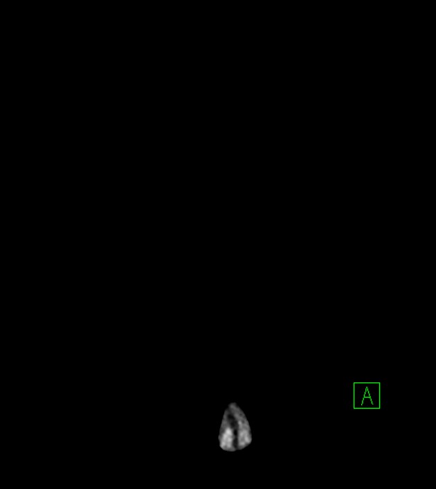 Anaplastic oligodendroglioma (Radiopaedia 79571-92753 Coronal non-contrast 2).jpg
