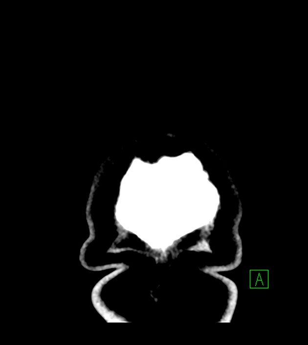 Anaplastic oligodendroglioma (Radiopaedia 79571-92753 Coronal non-contrast 71).jpg
