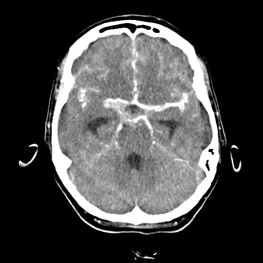 Aneursym related subarachnoid hemorrhage with hydrocephalus (Radiopaedia 45105-49084 D 18).jpg