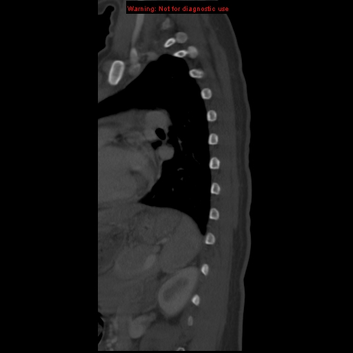 File:Aneurysmal bone cyst (Radiopaedia 9419-10102 Sagittal bone window 19).jpg
