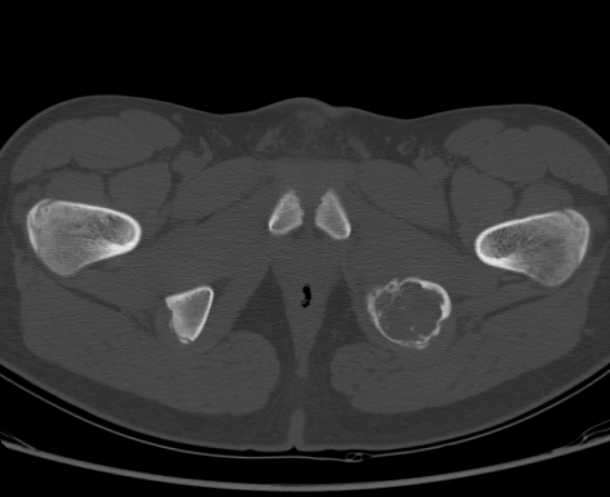 File:Aneurysmal bone cyst of ischium (Radiopaedia 25957-26094 Axial bone window 71).png