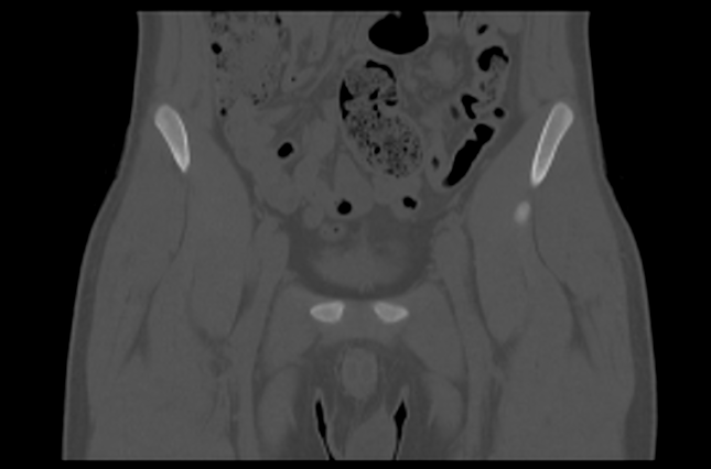 File:Aneurysmal bone cyst of ischium (Radiopaedia 25957-26094 Coronal bone window 7).png