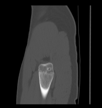 Aneurysmal bone cyst of ischium (Radiopaedia 25957-26094 Sagittal bone window 7).png