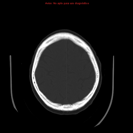 File:Aneurysmal subarachnoid hemorrhage (Radiopaedia 24740-24997 bone window 29).jpg
