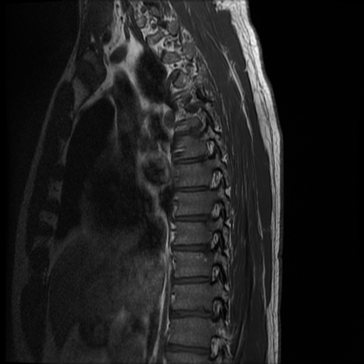 File:Angiolipoma - thoracic spine (Radiopaedia 28242-28479 Sagittal T1 11).jpg