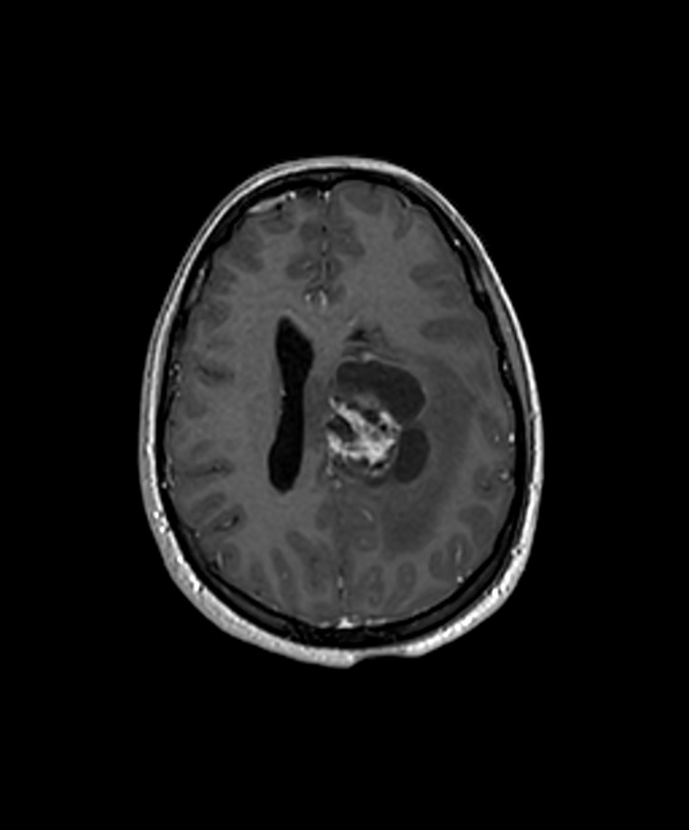 Angiomatous meningioma (Radiopaedia 79459-92577 Axial T1 C+ 3D ISO 21).jpg