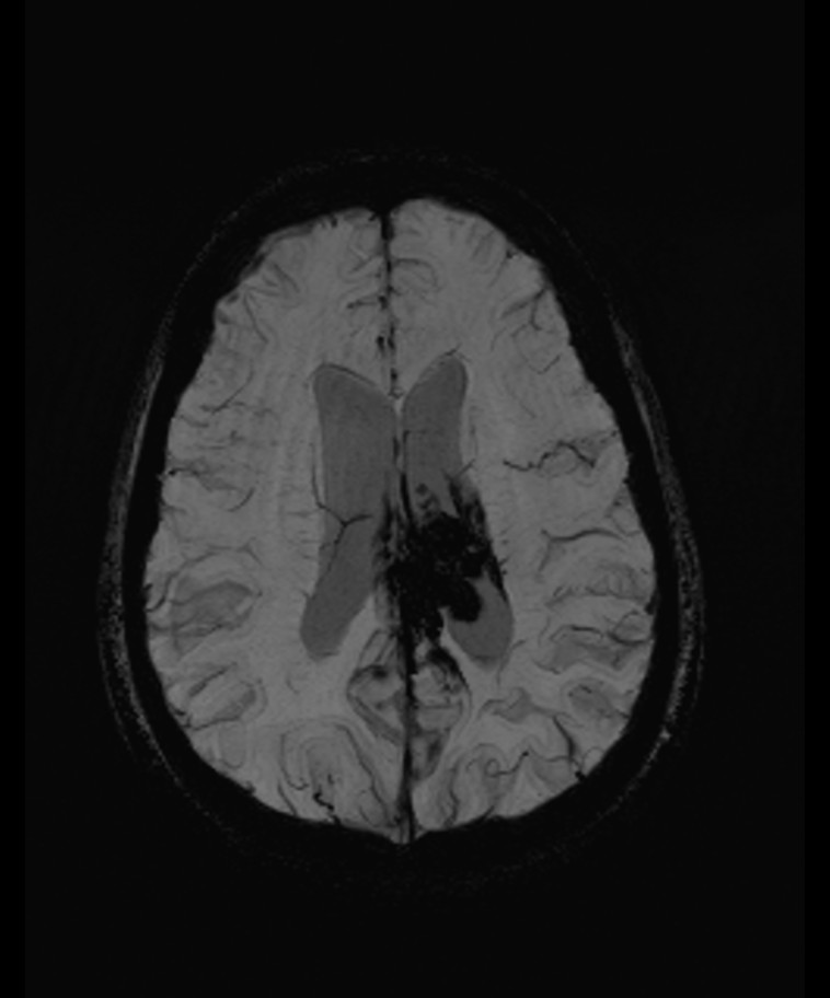 Angiomatous meningioma (Radiopaedia 79459-92579 E 43).jpg
