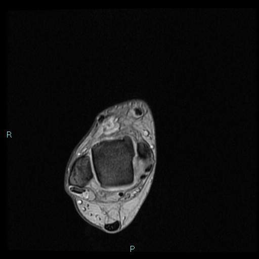 Ankle ganglion cyst (Radiopaedia 62809-71162 Axial Gradient Echo 60).jpg
