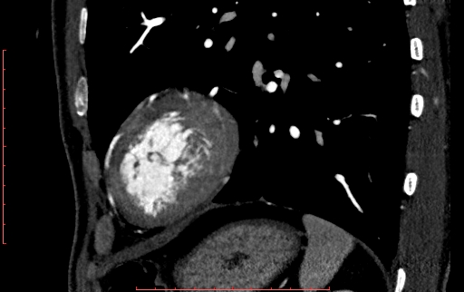Anomalous left coronary artery from the pulmonary artery (ALCAPA) (Radiopaedia 70148-80181 C 223).jpg