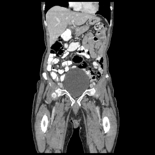 Anorectal carcinoma (Radiopaedia 44413-48064 B 20).jpg