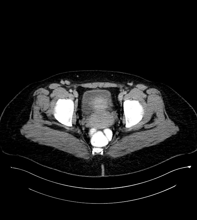 Anterior abdominal wall CSF pseudocyst (CSFoma) (Radiopaedia 79453-92571 A 84).jpg