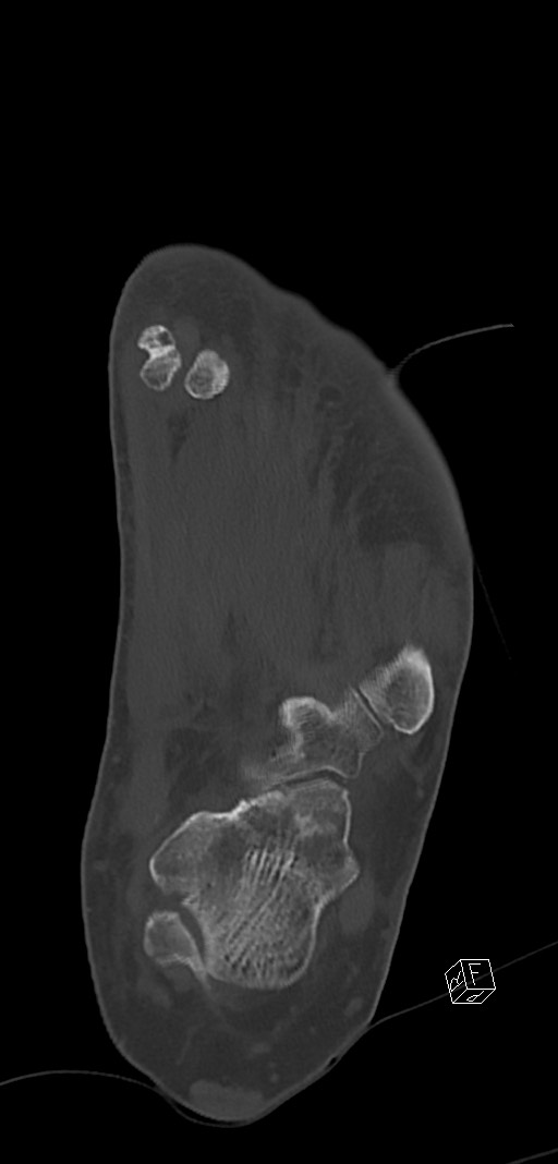 Anterior calcaneal process fracture (Radiopaedia 63353-71943 Coronal bone window 32).jpg