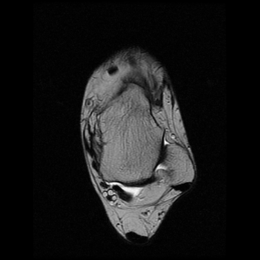 File:Anterior calcaneal process fracture (Radiopaedia 74654-85611 Axial T2 10).jpg
