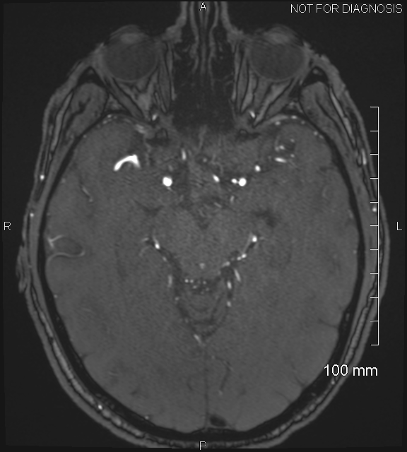 Anterior cerebral artery aneurysm (Radiopaedia 80683-94127 Axial MRA 99).jpg