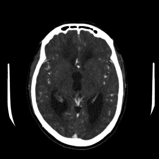 File:Anterior communicating artery aneurysm (Radiopaedia 16633-16335 A 21).jpg
