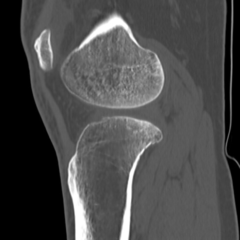 File:Anterior cruciate ligament avulsion fracture (Radiopaedia 58939-66194 Sagittal bone window 12).jpg