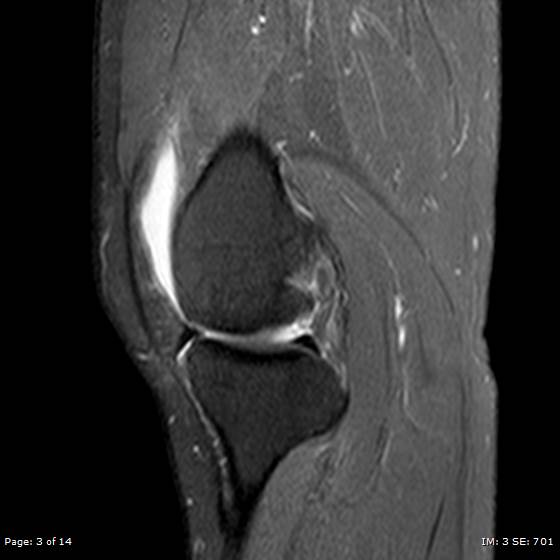 File:Anterior cruciate ligament tear (Radiopaedia 70783-80964 Sagittal PD fat sat 3).jpg
