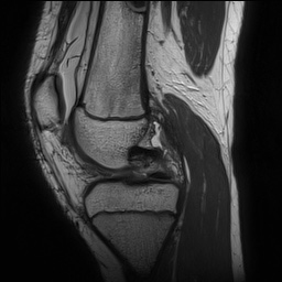 Anterior cruciate ligament tear - pediatric (Radiopaedia 62152-70260 Sagittal PD 72).jpg