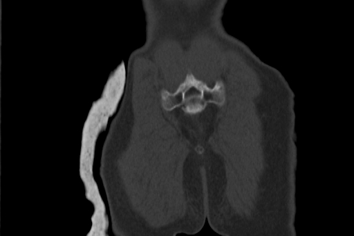 Anterior inferior iliac spine avulsion injury (Radiopaedia 88666-105376 Coronal bone window 65).jpg