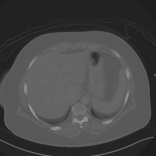 Anterior superior iliac spine avulsion fracture (Radiopaedia 44541-48244 Axial bone window 19).png