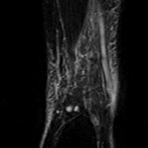 File:Anterior talofibular ligament rupture (Radiopaedia 15831-15484 Coronal STIR 22).jpg
