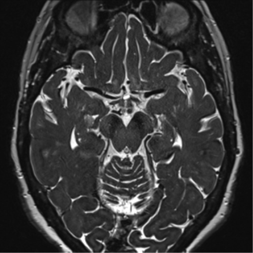 Anterior temporal pole cysts (Radiopaedia 46629-51102 Axial 52).png