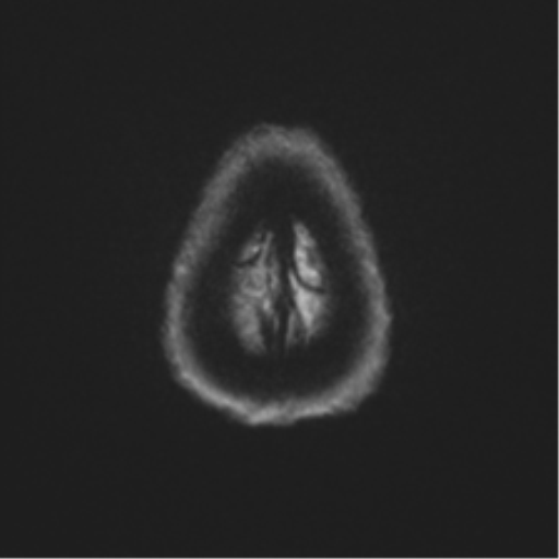File:Anterior temporal pole cysts (Radiopaedia 46629-51102 Axial DWI 54).png