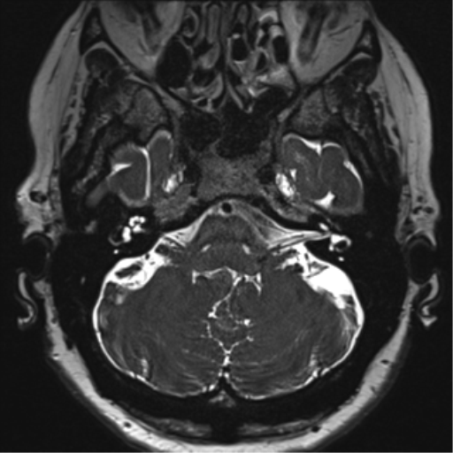 File:Anterior temporal pole cysts (Radiopaedia 46629-51102 Axial T2 29).png