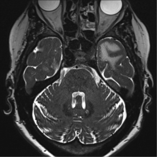 Anterior temporal pole cysts (Radiopaedia 46629-51102 Axial T2 47).png