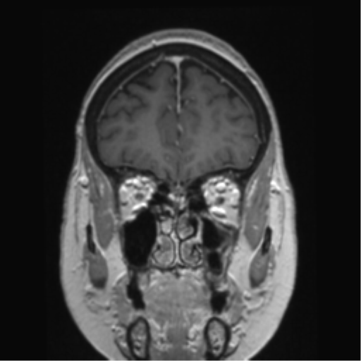 Anterior temporal pole cysts (Radiopaedia 46629-51102 Coronal T1 C+ 136).png